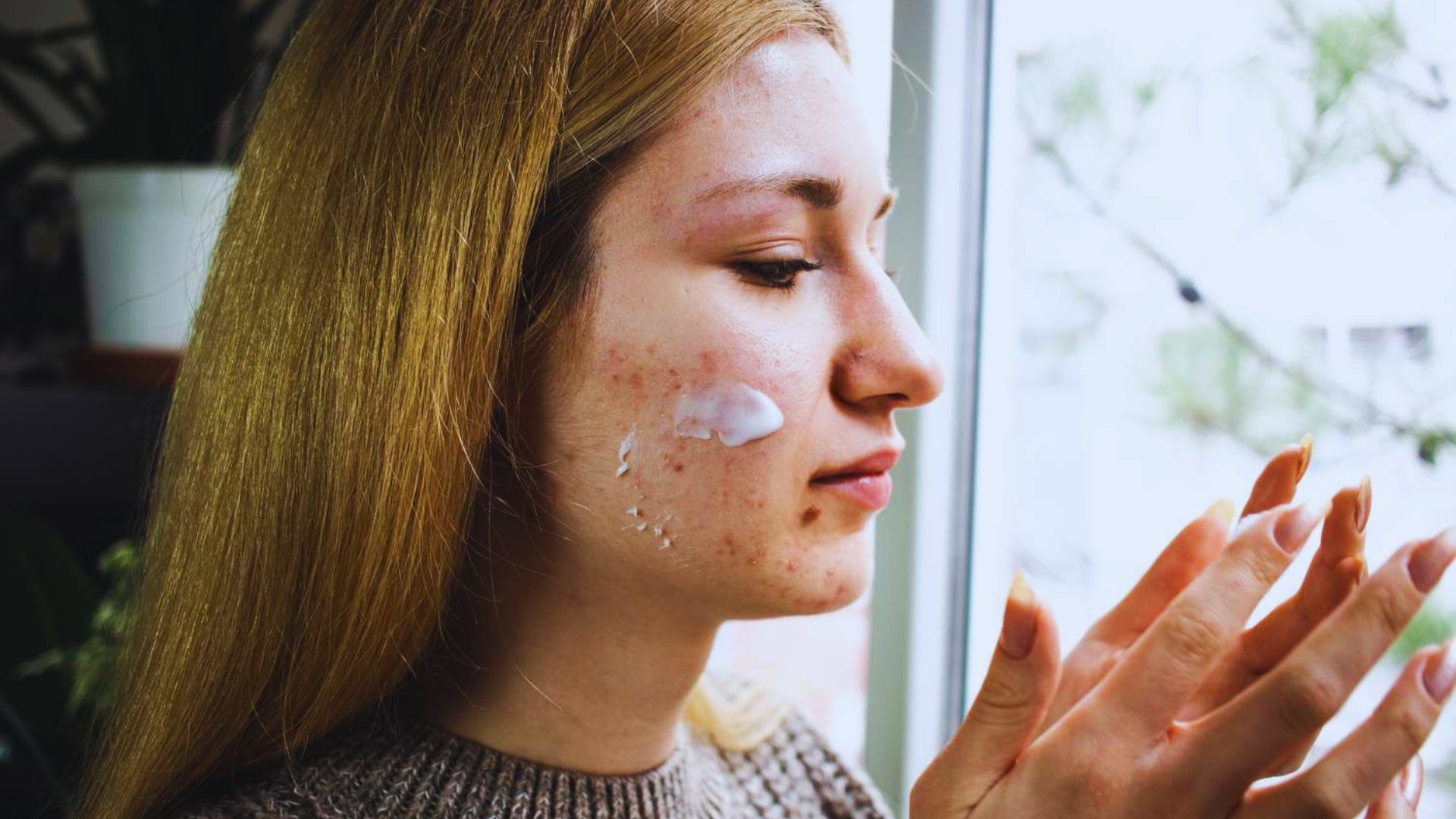 A woman applying acne cream on her face, focusing on skincare and treatment for blemishes.