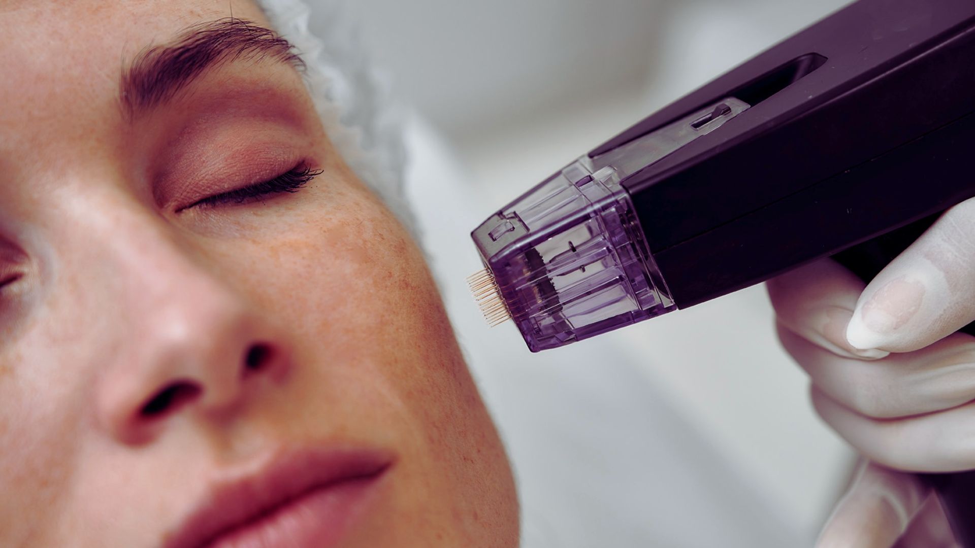 A woman receiving a laser treatment on her face in a clinical setting, focused on skincare and rejuvenation.