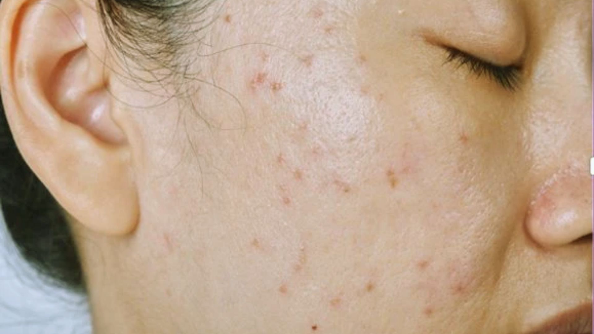 Close-up of a person's cheek with closed eyes, showing acne scars and blemishes on smooth skin. The image conveys a sense of calm and vulnerability.