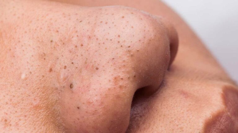 Close-up of a person's nose with visible blackheads and skin pores. The lighting highlights the skin texture, conveying a focus on skincare concerns.