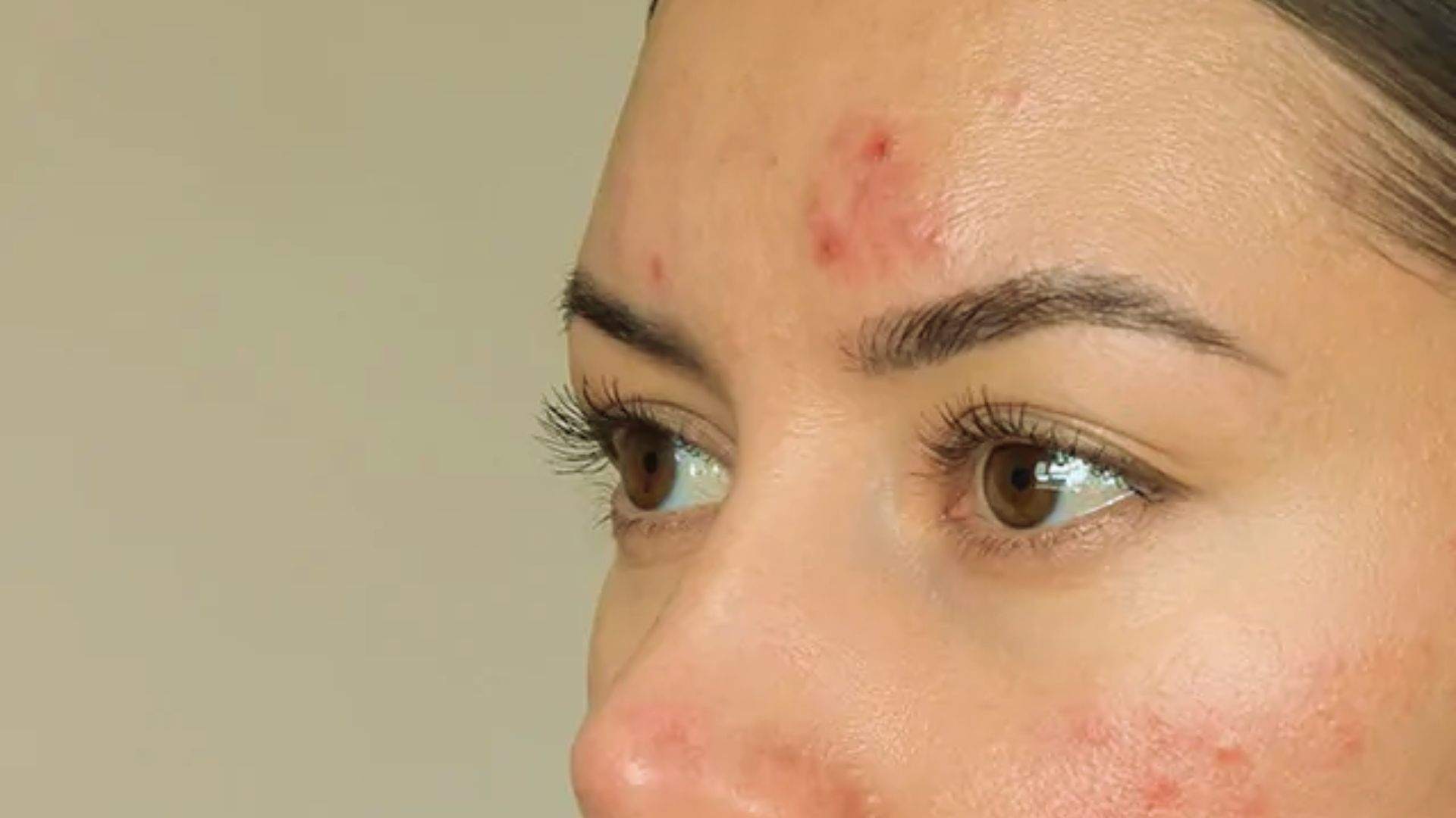 Close-up of a person's face showing visible acne on the forehead and cheek. The skin appears slightly irritated, suggesting mild discomfort.