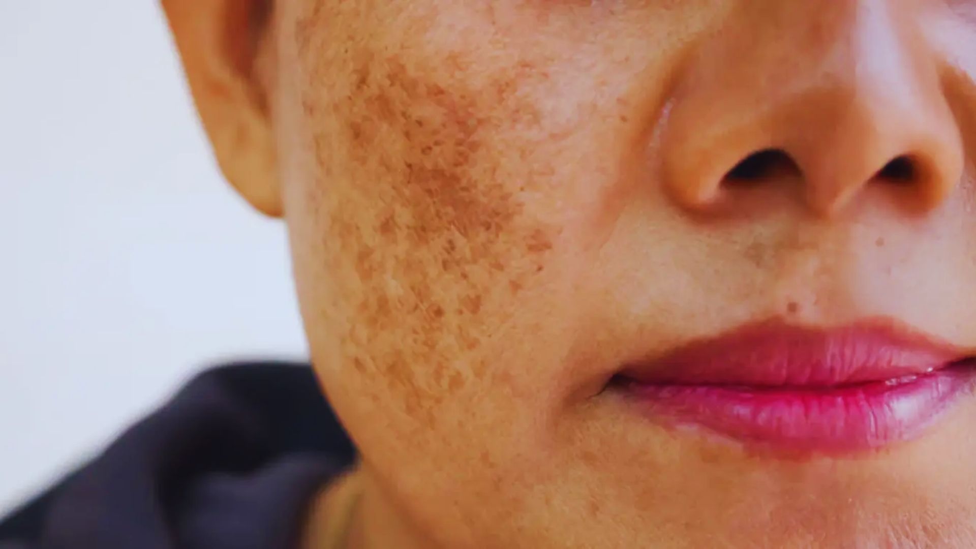 Close-up of the lower half of a person's face with visible facial pigmentation on the cheek. The lips are slightly curved and colored with pink lipstick.
