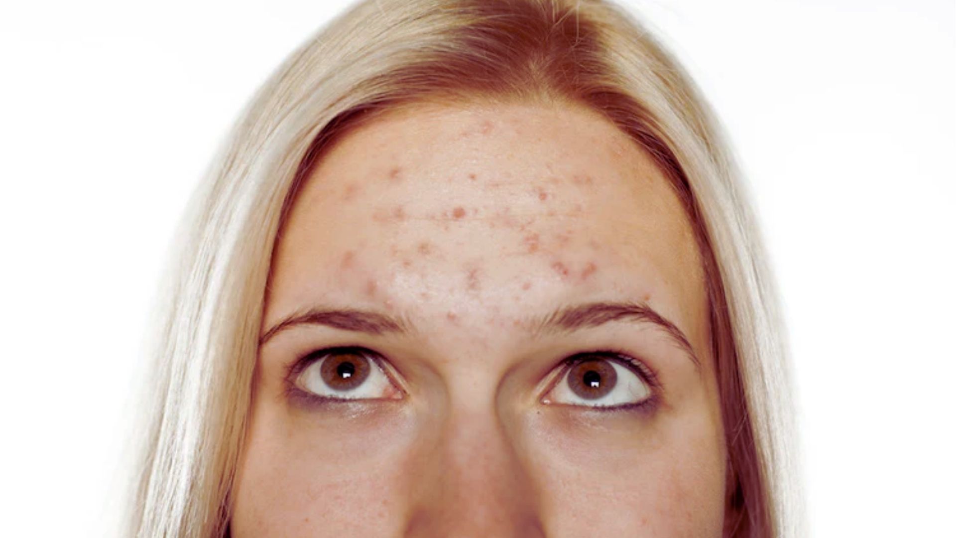 Close-up of a person with blonde hair looking upwards, showing a forehead with acne. The expression suggests curiosity or contemplation. White background.