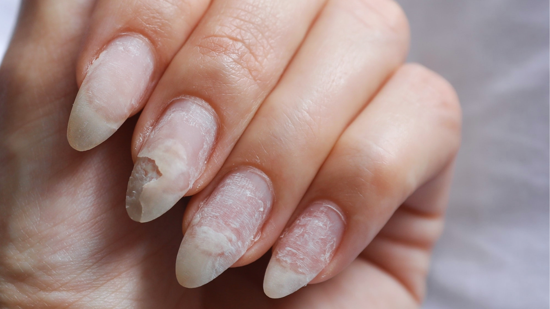 Close-up of a hand with damaged nails showing peeling and brittleness. The nails appear rough and cracked, suggesting signs of neglect or health issues.