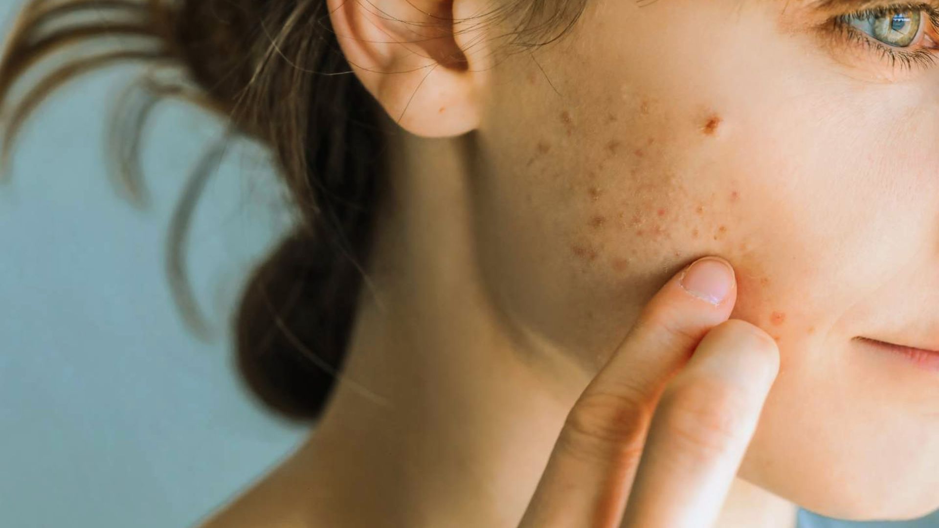 Close-up of a person gently touching their cheek with visible acne scars. The expression is neutral. The background is soft blue, creating a calm tone.
