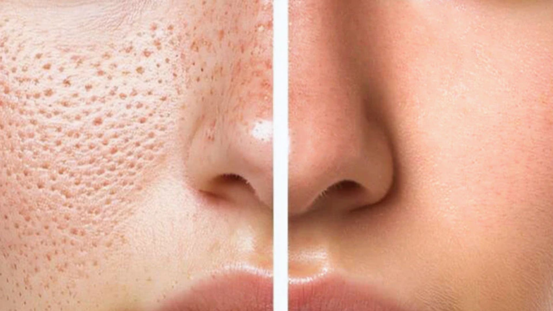 Close-up of a face split in half; the left side shows large pores and uneven texture, while the right side is smooth and clear, suggesting skin improvement.