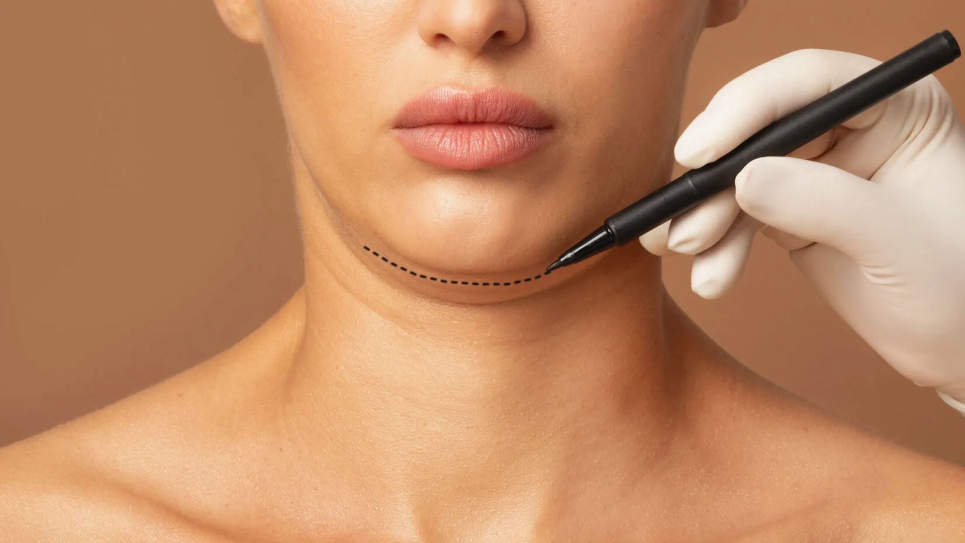 Close-up of a woman's lower face and neck with a dotted line drawn along the jawline. A gloved hand holds a marker, suggesting cosmetic surgery planning.