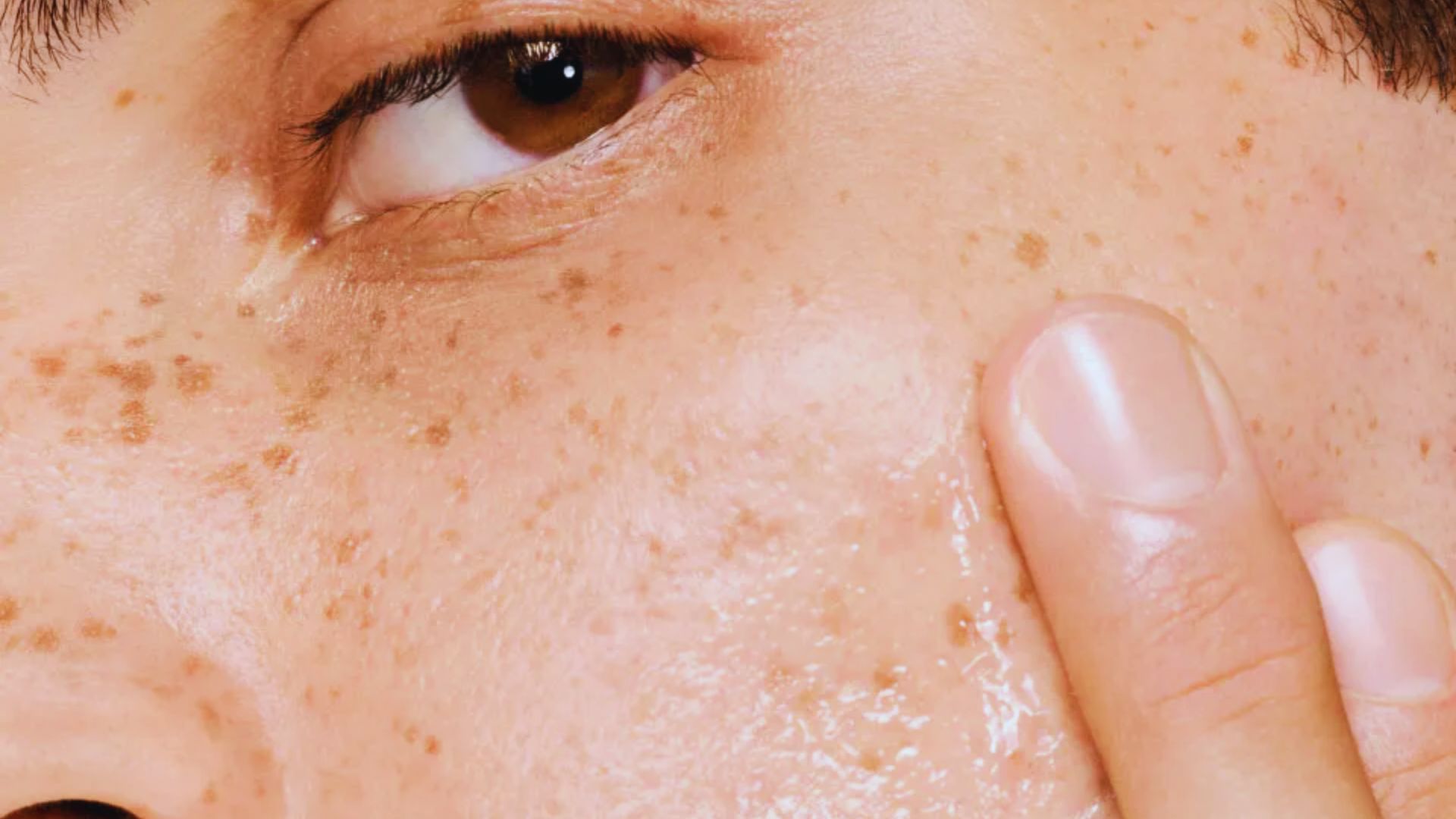 Close-up of a person’s face with freckles, focusing on an eye and cheek. A finger gently touches the skin, which appears moisturized and healthy.