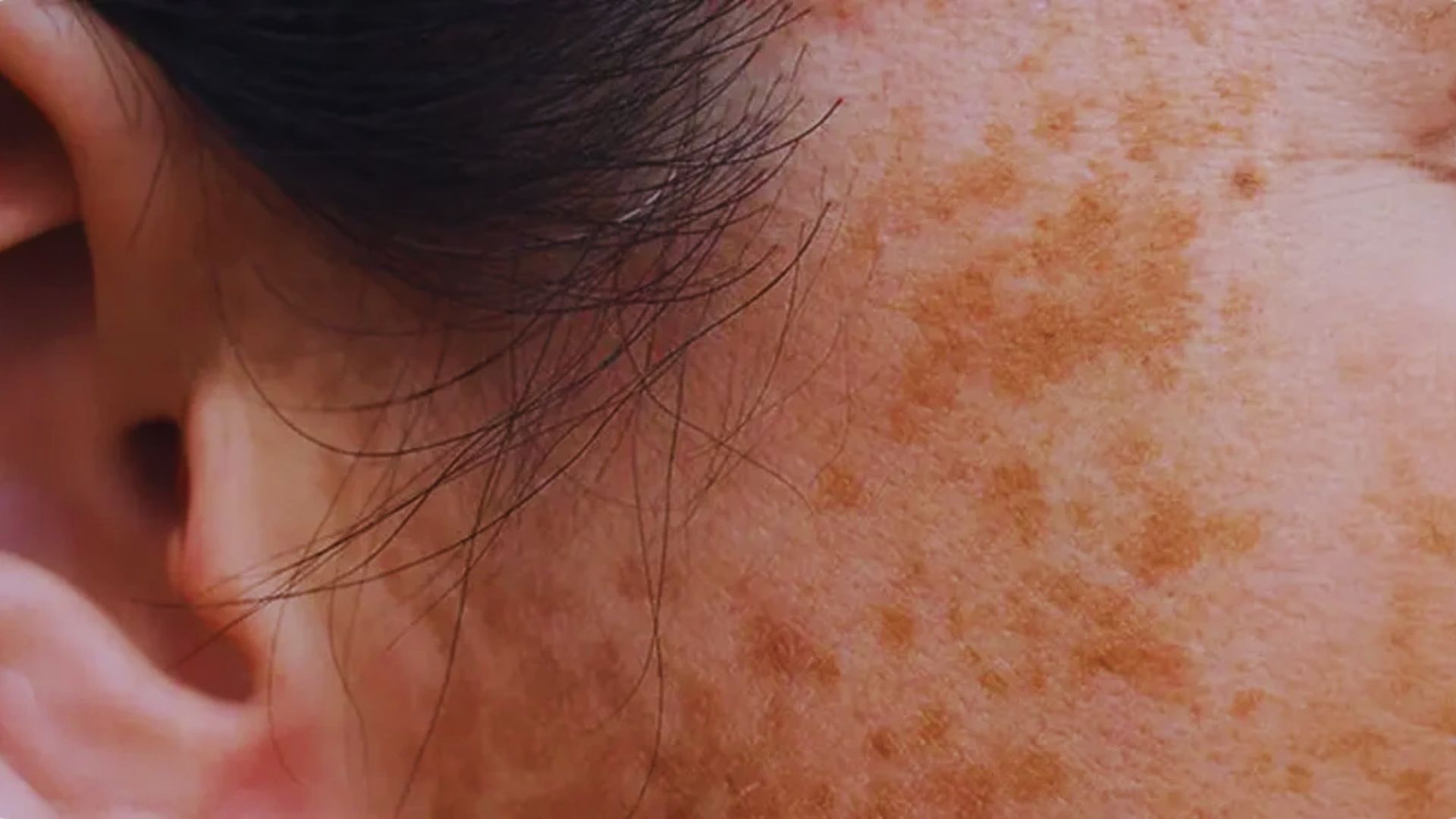 Close-up of a person's cheek and ear showing brown pigmented spots on the skin, indicating hyperpigmentation, with dark hair strands visible.