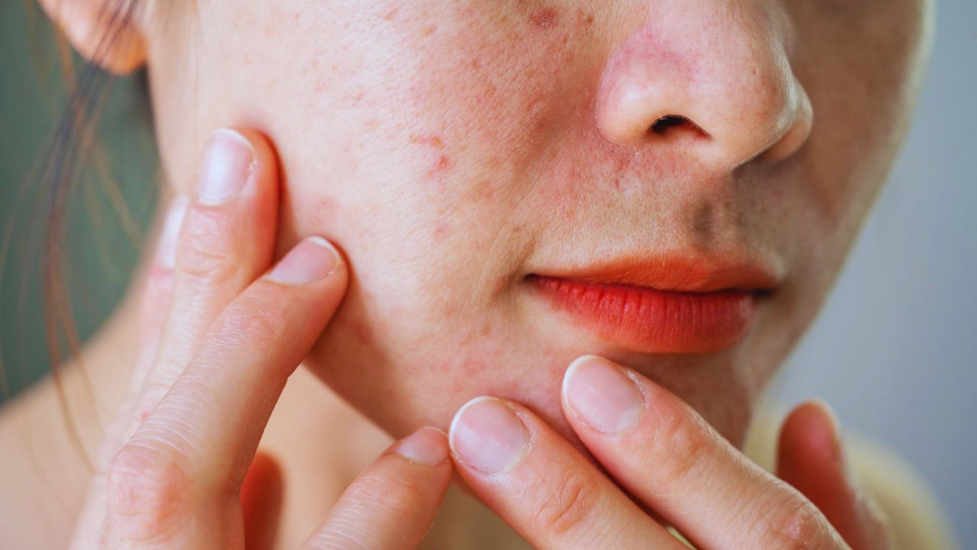 Close-up of a person touching their cheek, showing red acne and blemishes. The skin appears irritated, conveying concern or focus on skincare issues.