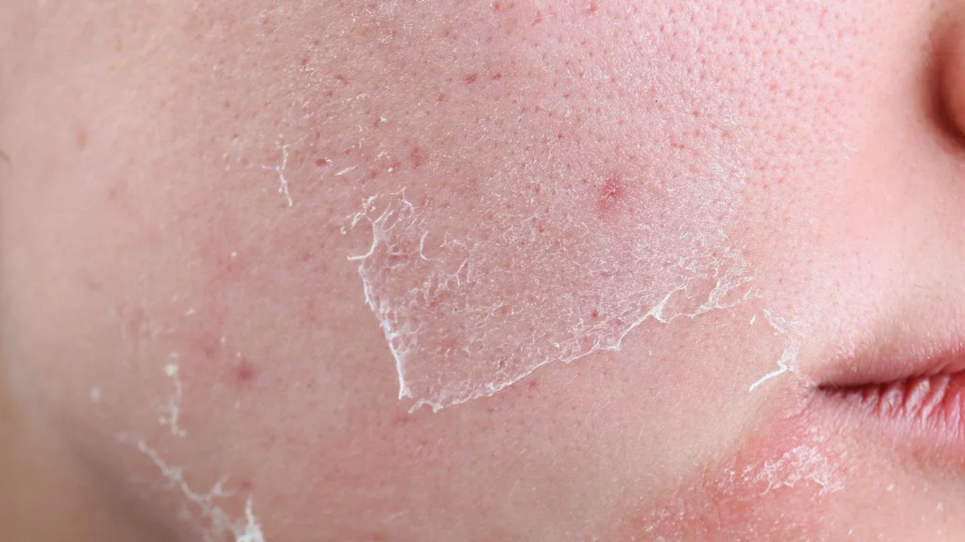Close-up of dry, peeling skin on a person's face, highlighting texture and redness. The image conveys a sense of discomfort and sensitivity.