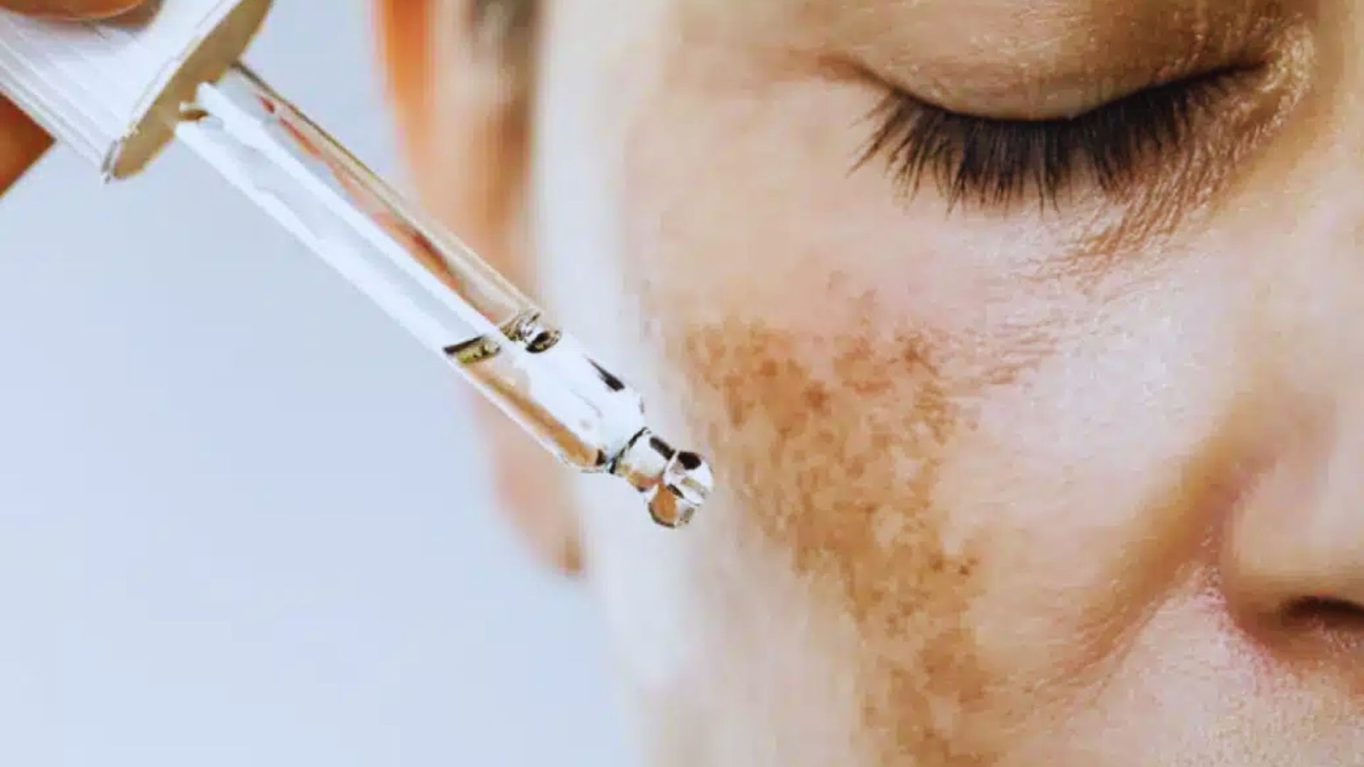 A dropper applying serum to a person's cheek with visible skin pigmentation. The image conveys skincare treatment and highlights skin texture and care routines.