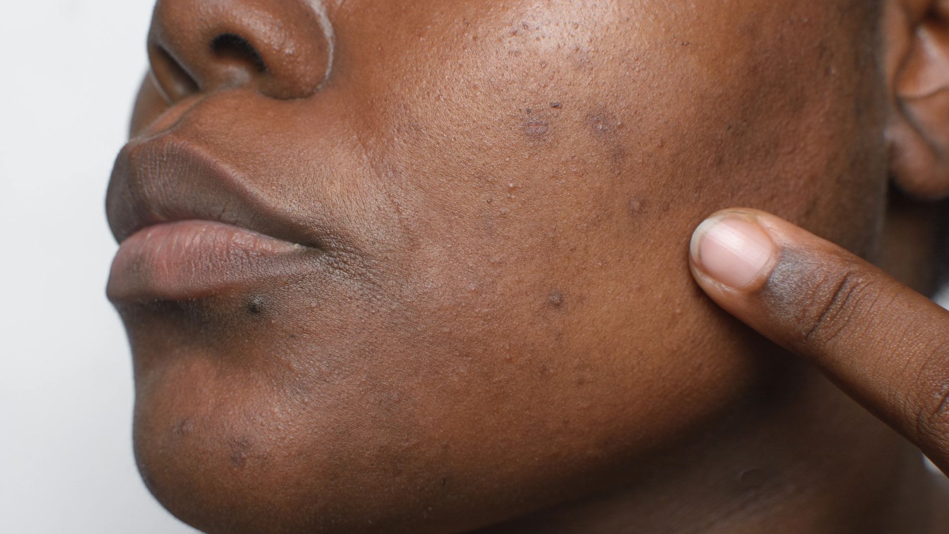Close-up of a person's cheek showing acne scars and uneven skin texture. A finger gently touches the skin, highlighting the area of concern.