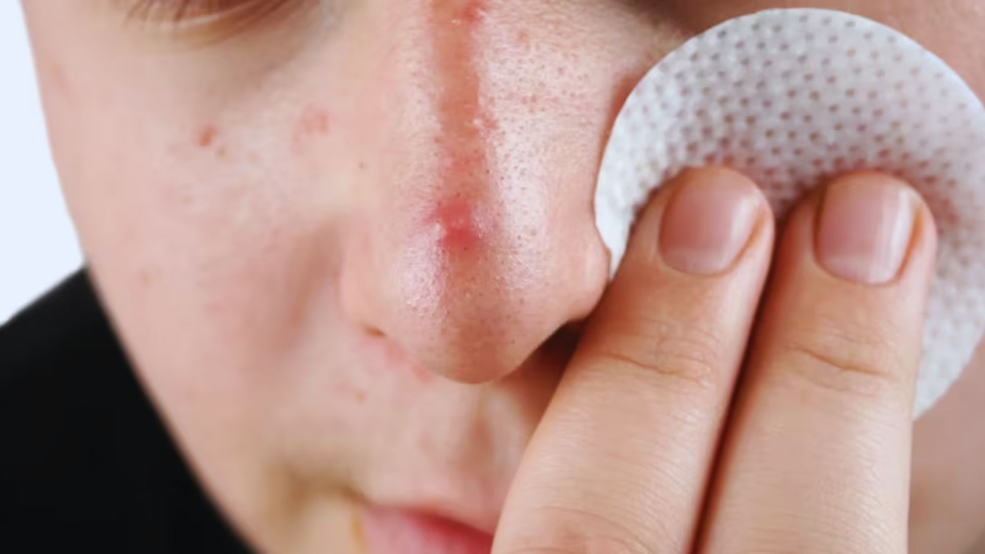 Close-up of a person using a cotton pad on a red pimple on their nose. The texture of the skin and focus on skincare convey a sense of self-care.