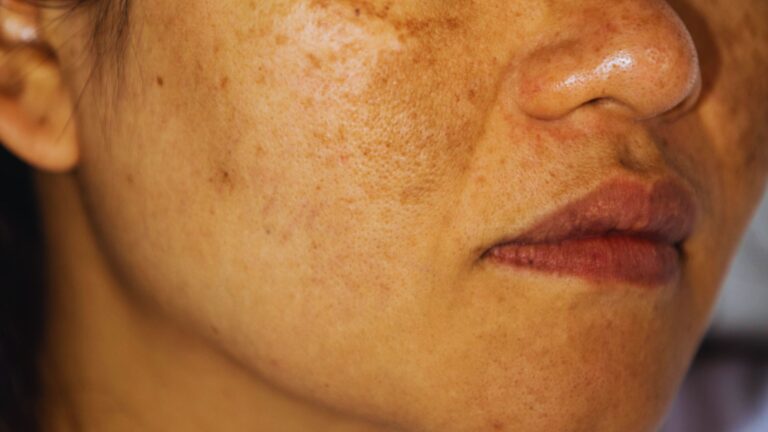 Close-up of a woman's cheek and lips showing visible hyperpigmentation and freckles, with a smooth texture and natural, relaxed expression.