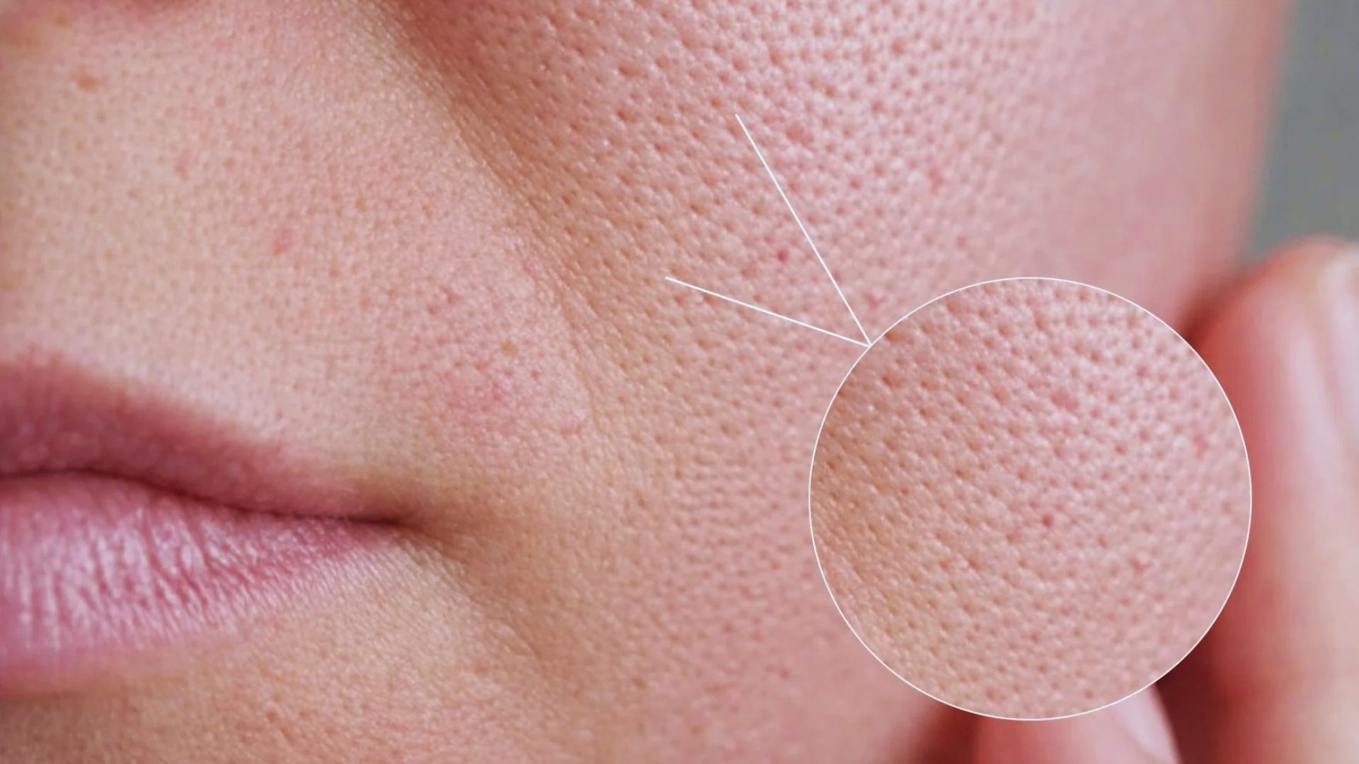 Close-up of facial skin with enlarged pores highlighted by a circular inset. The image features smooth lips and skin texture, emphasizing pore detail.