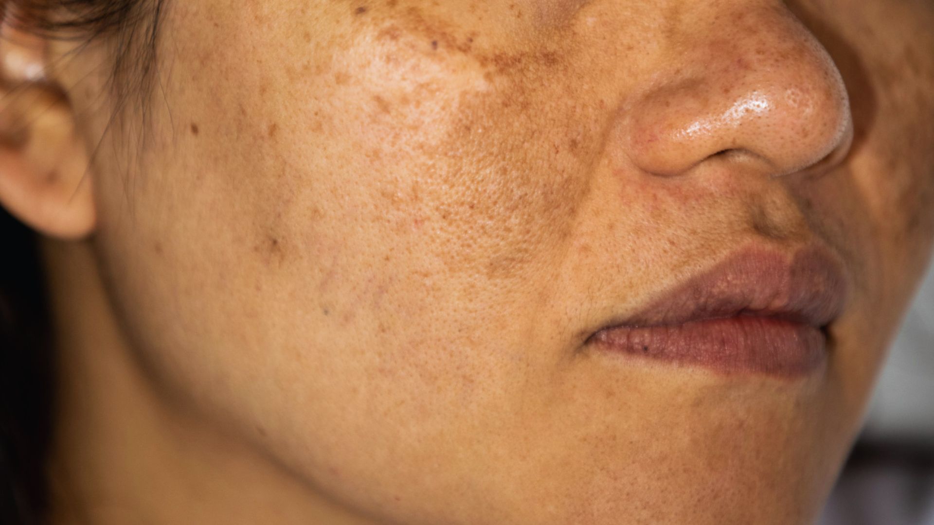 Close-up of a woman's face showing hyperpigmentation and uneven skin tone on the cheek. The expression is neutral, highlighting skin texture.