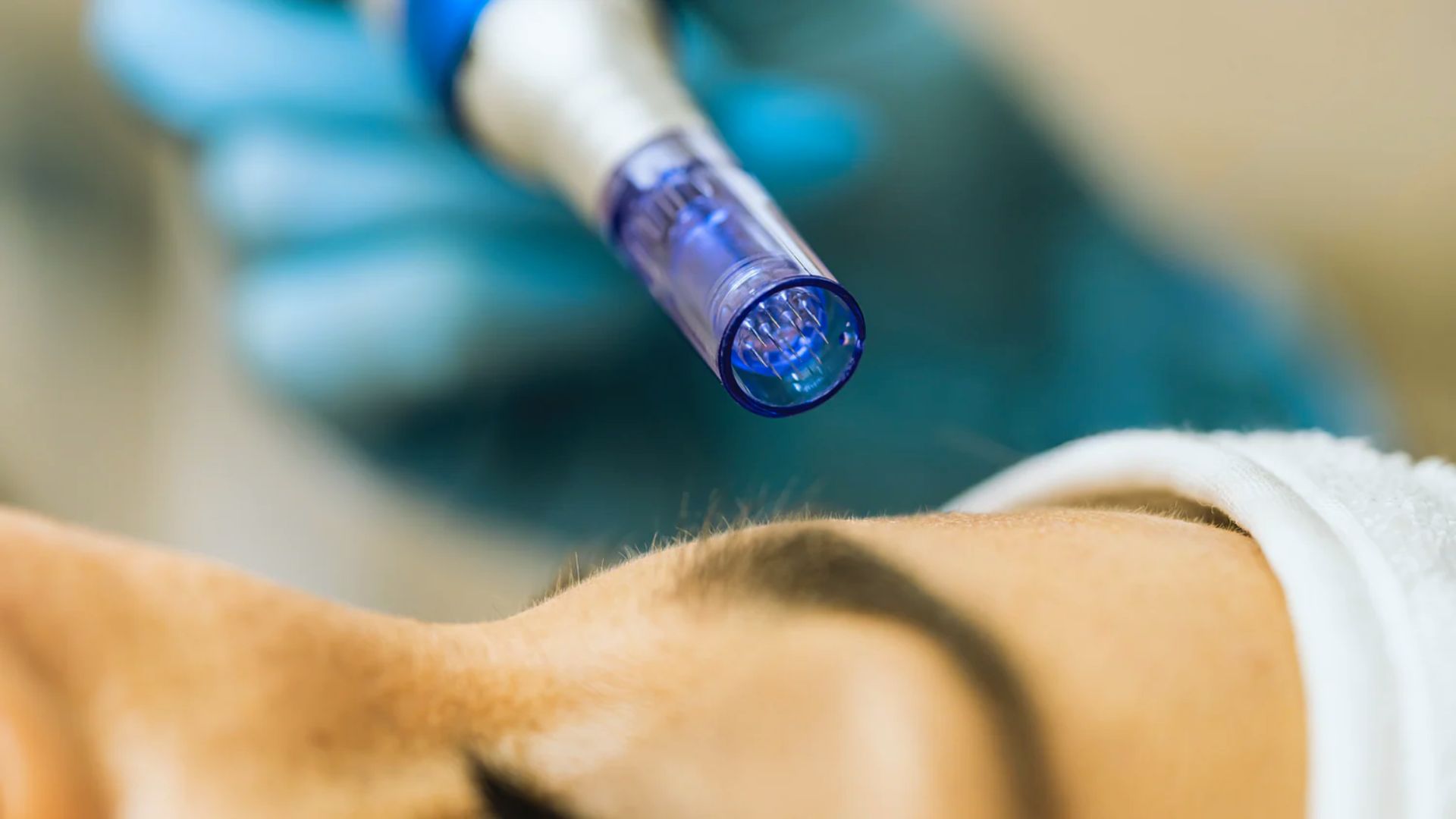 A close-up of a skincare procedure shows a blue-handled dermapen approaching a person's forehead. The patient appears relaxed under a white towel.