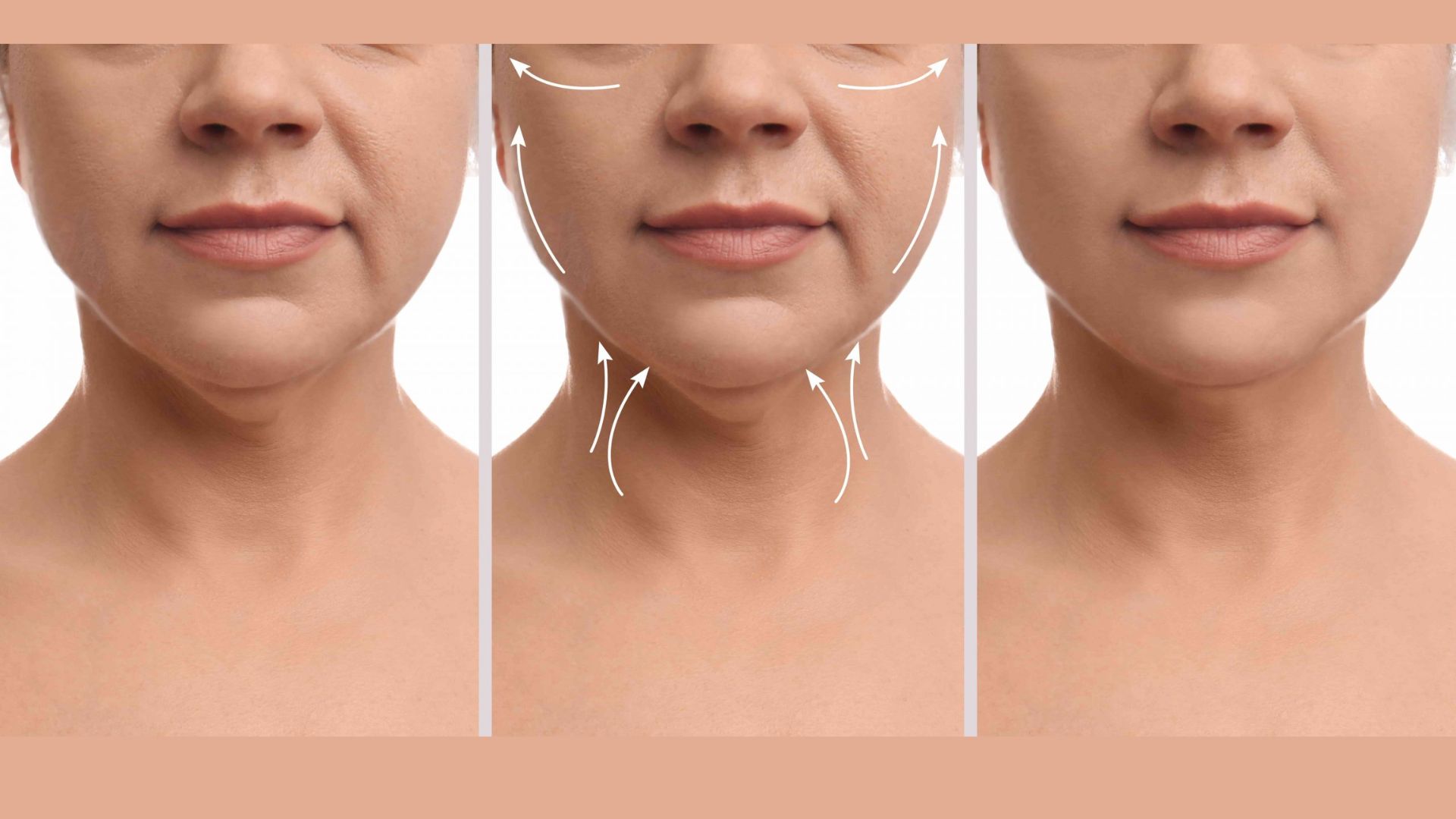 Three images show the lower face and neck of a person: left, before cosmetic treatment; center, with lifting arrows; right, after treatment, with smoother skin.