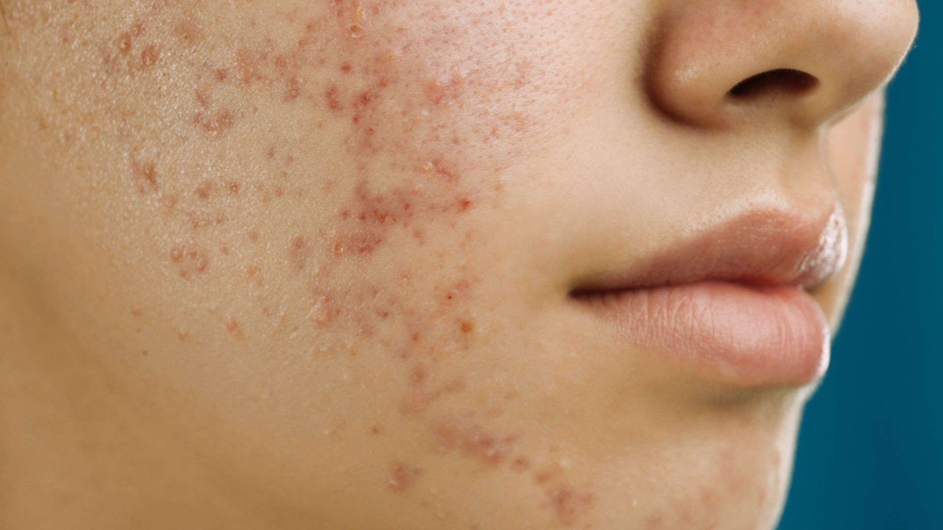 Close-up of a person's cheek with visible acne, including red blemishes and inflammation. The background is a solid teal color, conveying a clinical focus.