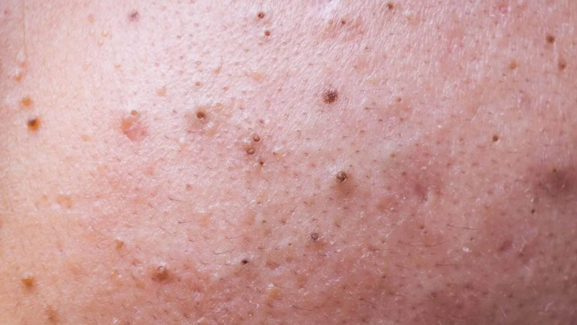 Close-up of human skin showing multiple small moles and imperfections. The texture is slightly bumpy, with varying shades of pink and brown.