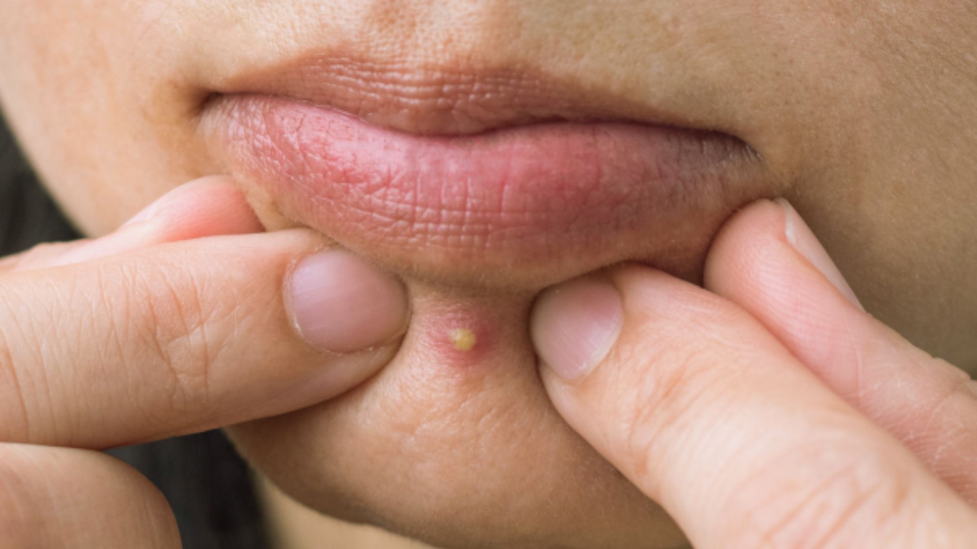 A person gently squeezes a pimple on their chin with both hands. The skin appears slightly red, and the mood suggests discomfort or concern.