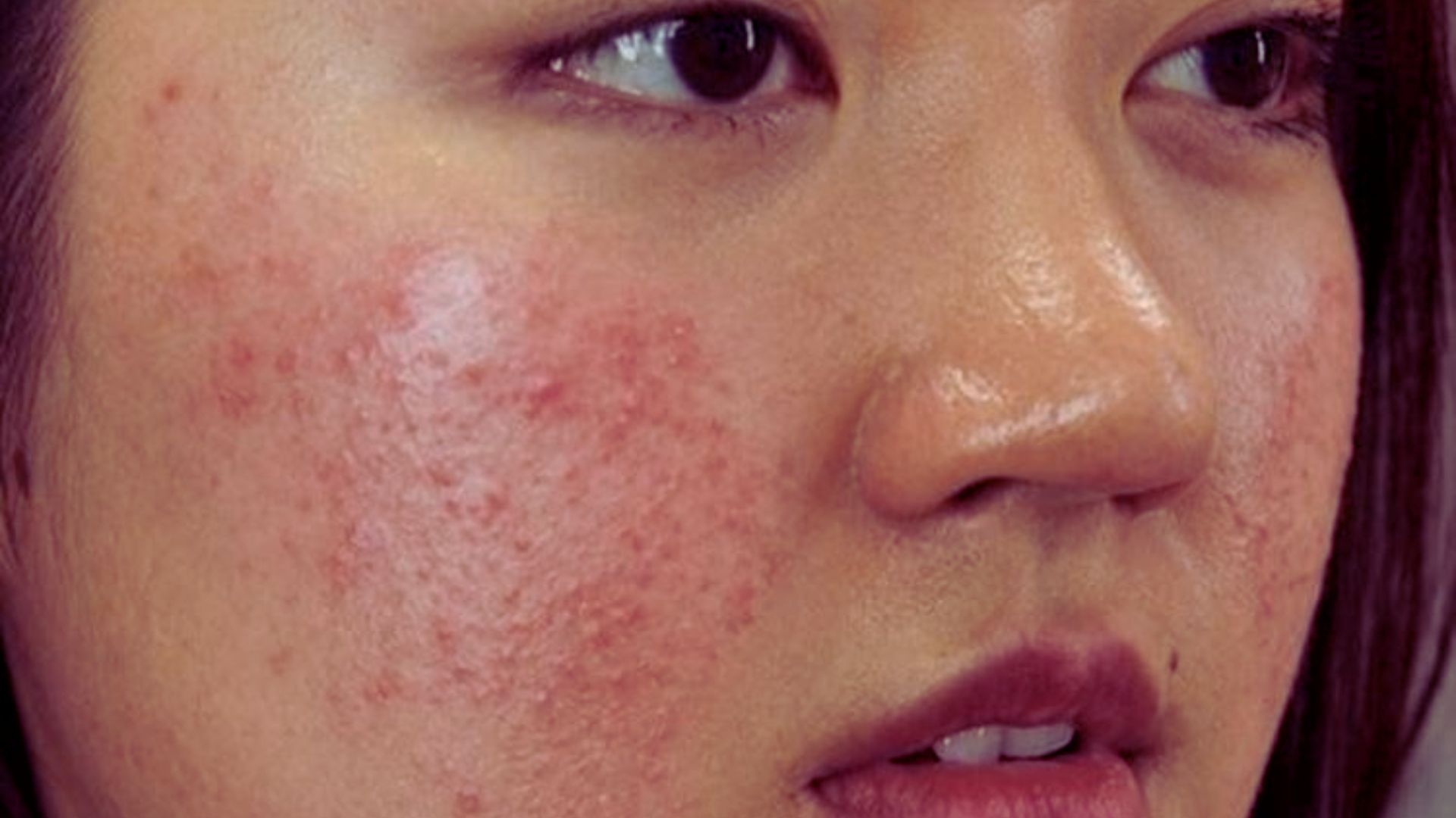 Close-up of a woman's face showing red acne scars and blemishes on the cheek. Her expression is neutral, and the image conveys a focus on skin texture.