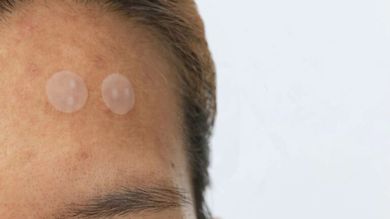 Close-up of a forehead with two transparent acne patches applied, emphasizing skincare. The image has a clean, minimalistic background.
