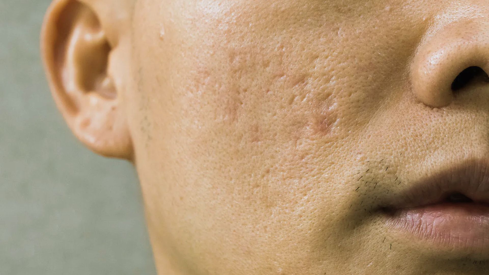 Close-up of a person's face showing visible acne scars and textured skin on the cheek. The expression is neutral with a focus on skin texture.