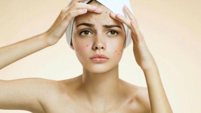 A young woman with a towel on her head examines her acne-prone skin with a concerned expression. Her hands touch her forehead thoughtfully.
