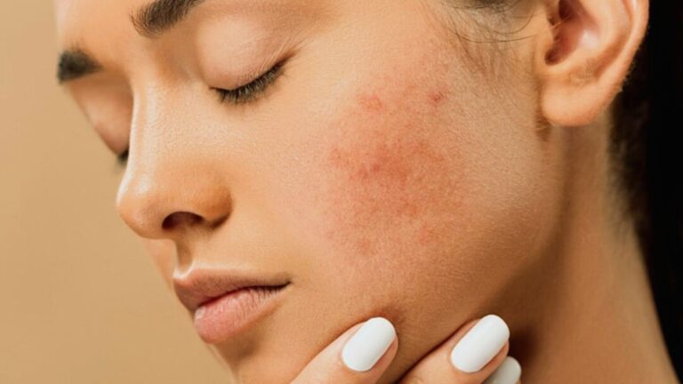 Woman with closed eyes, touching her cheek covered in red acne spots. Her expression is calm. Background is a neutral beige. Keywords: acne, skincare.