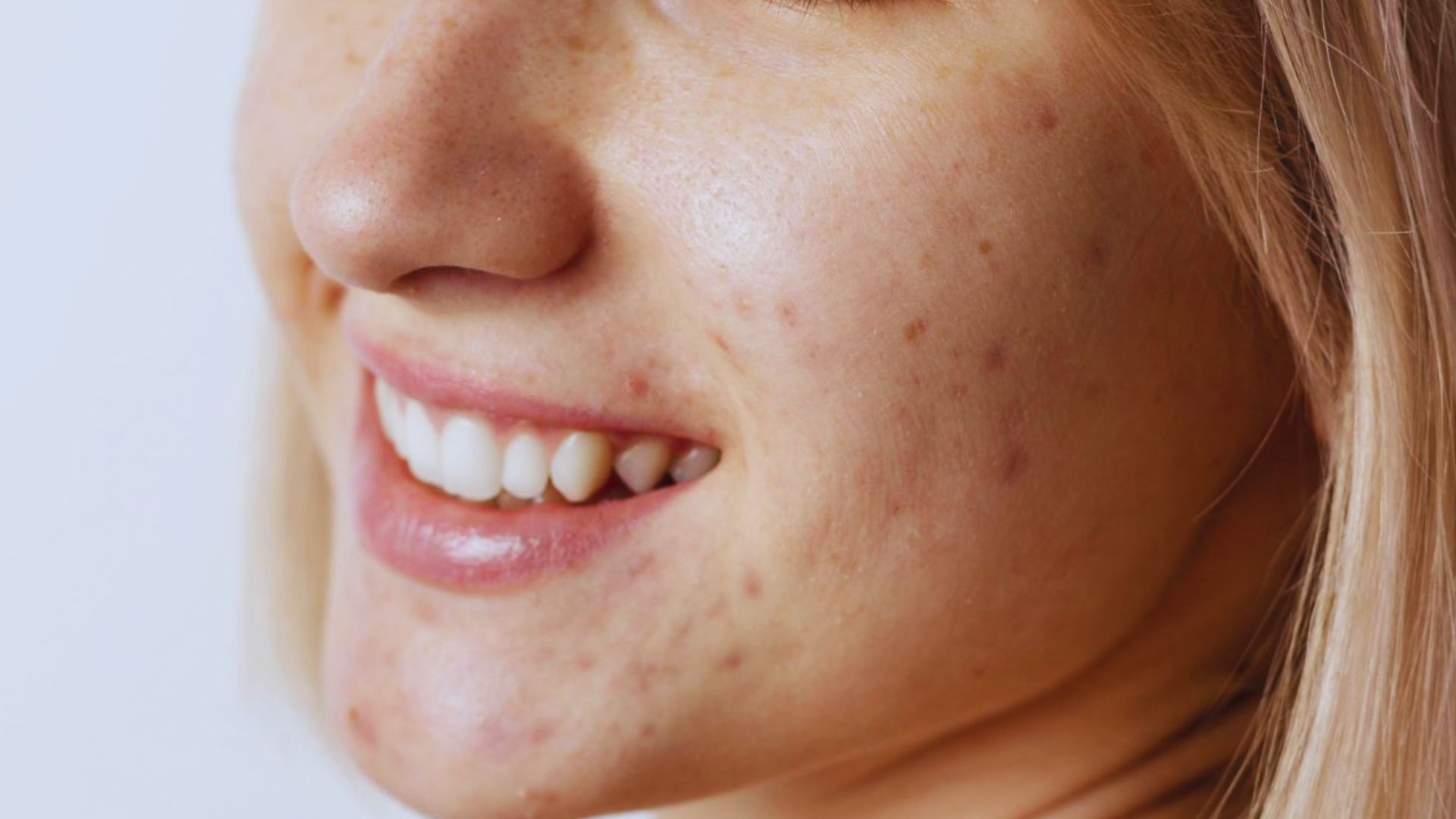 Close-up of a person smiling, showing clear, healthy teeth. The skin has visible light acne marks, conveying a natural and genuine appearance.