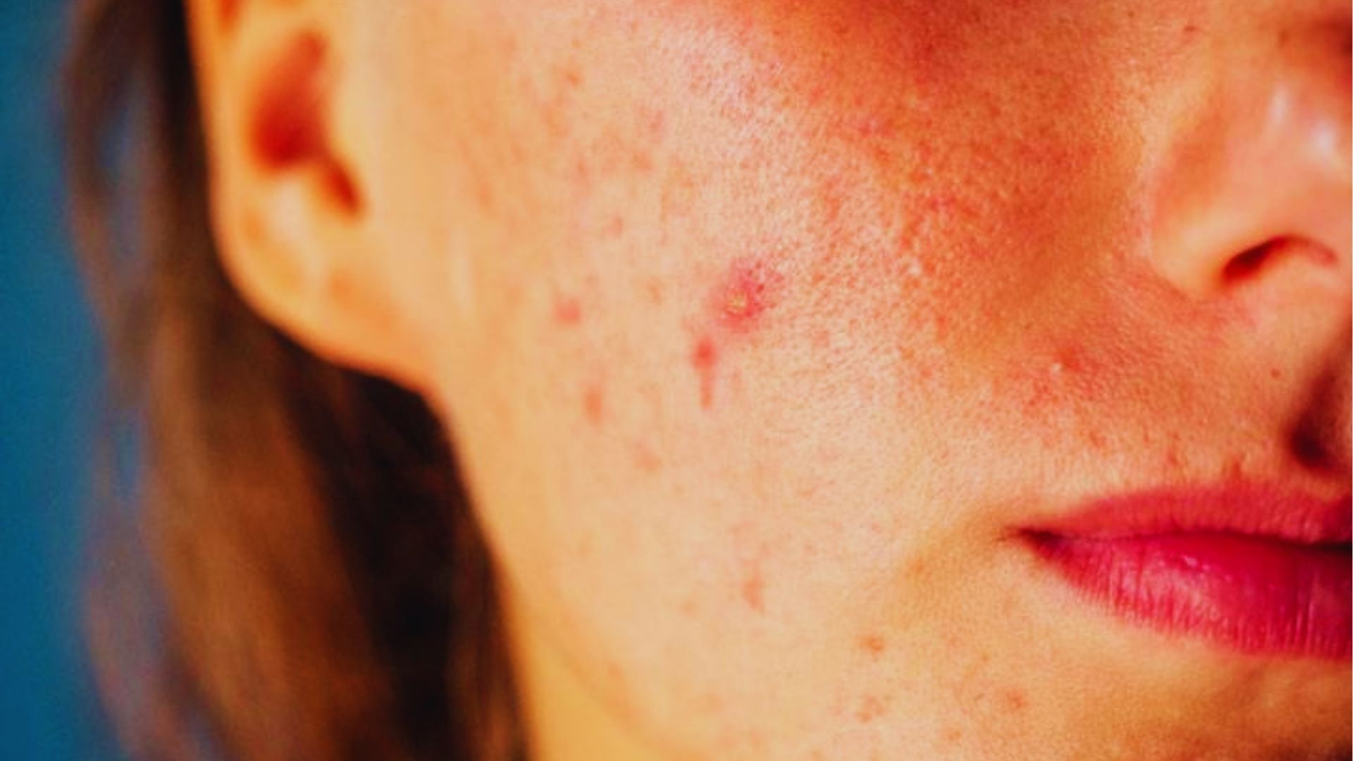 Close-up of the right side of a person's face with visible acne and redness. The expression is neutral, conveying a natural, unretouched tone.