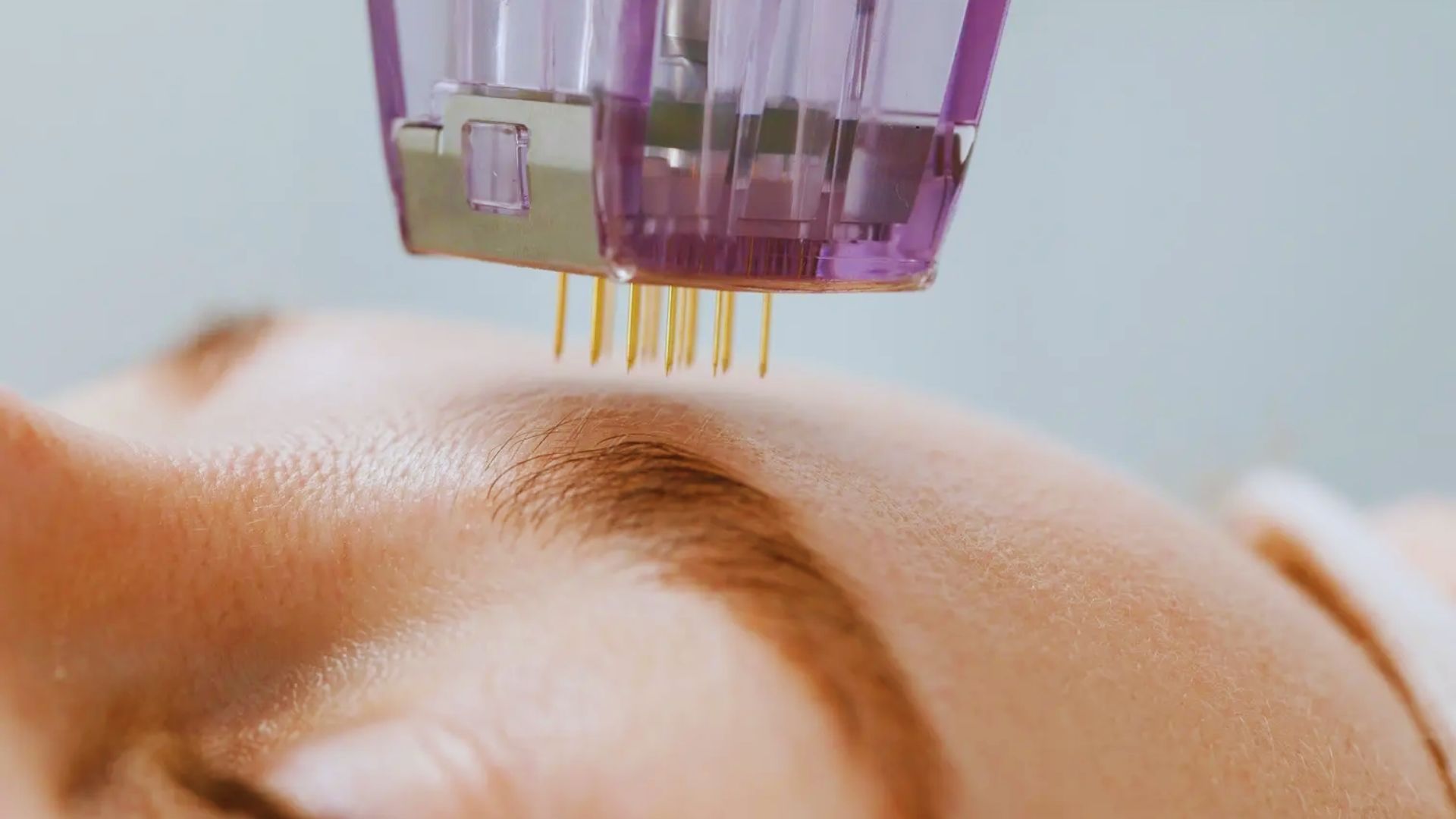 A woman receiving a laser treatment on her face in a clinical setting, focused on skincare and rejuvenation.