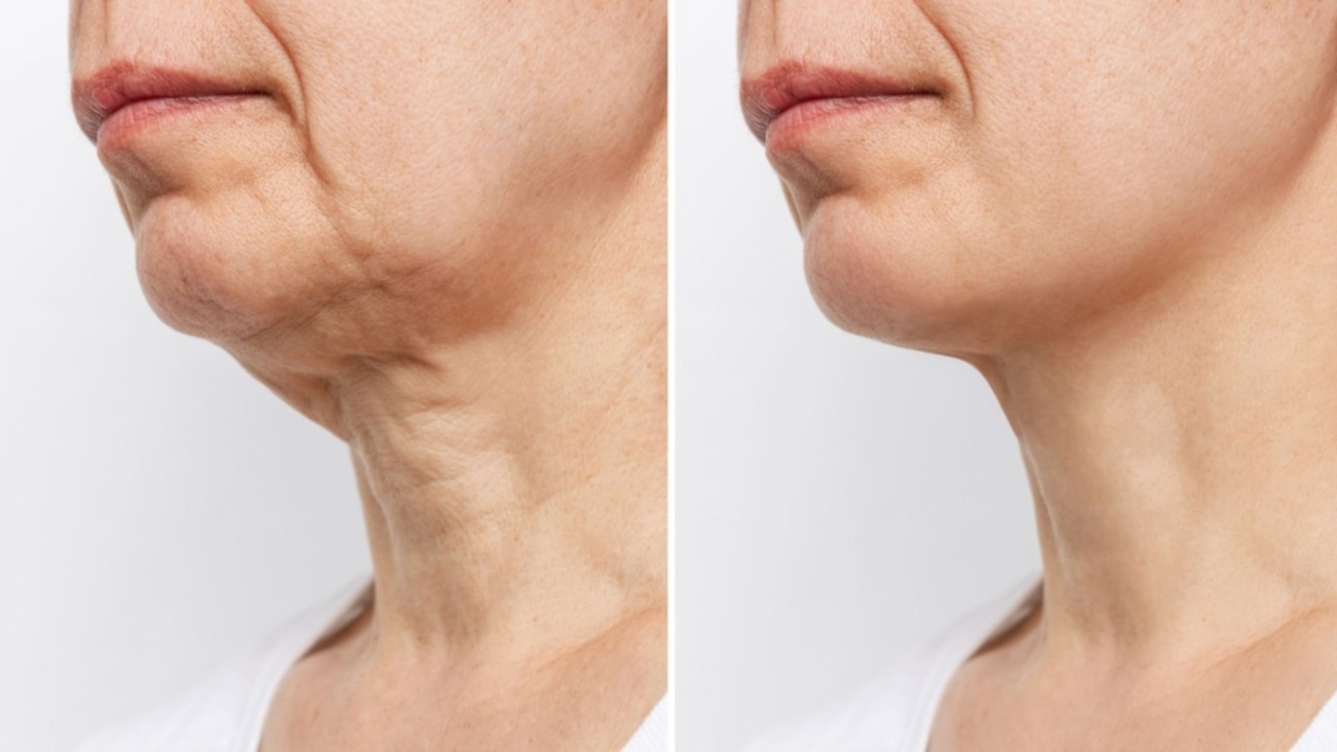 Side-by-side images of a person's lower face and neck show a "before" on the left with sagging skin, and an "after" on the right with firmer skin.