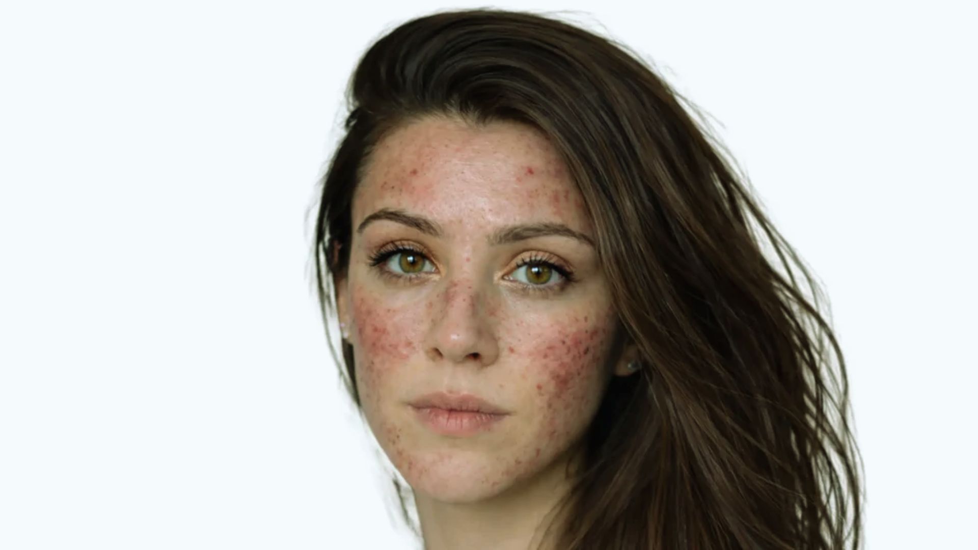 A young woman with long brown hair looks into the camera with a neutral expression. Her face shows visible signs of acne. The background is plain white.