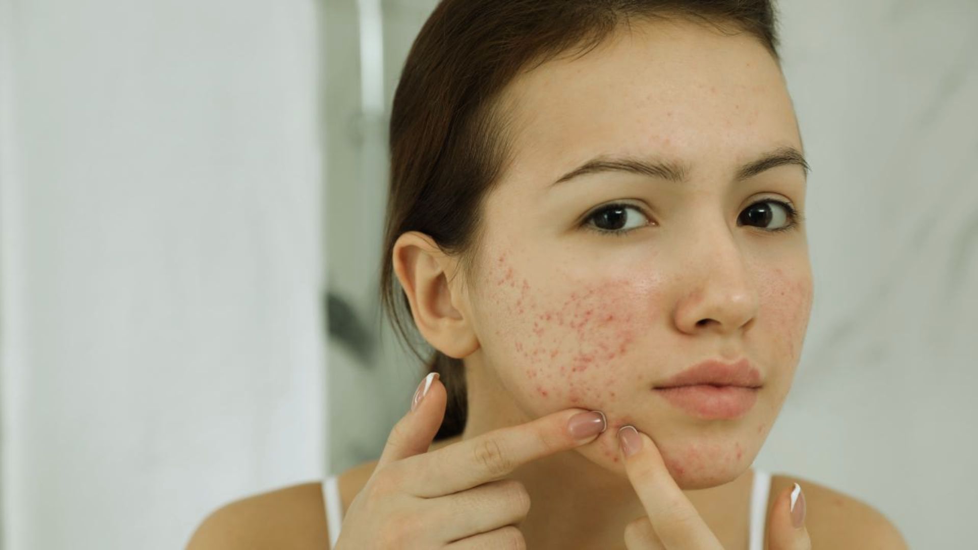A young person with acne presses a finger on their cheek, examining their skin in a mirror. The setting is bright and neutral, conveying a sense of concern.