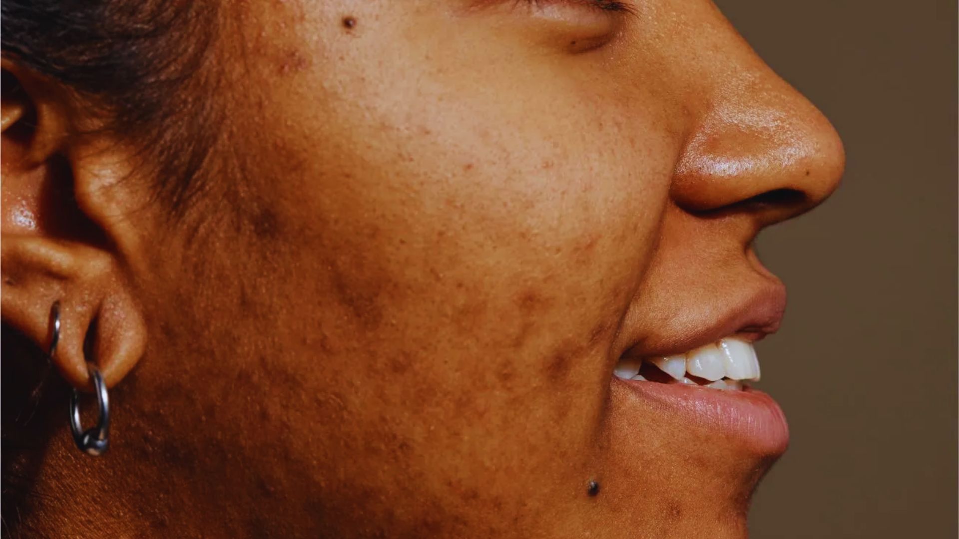 Close-up profile of a person smiling gently. Visible are textured skin with scars, a small earring, and a serene expression against a neutral background.