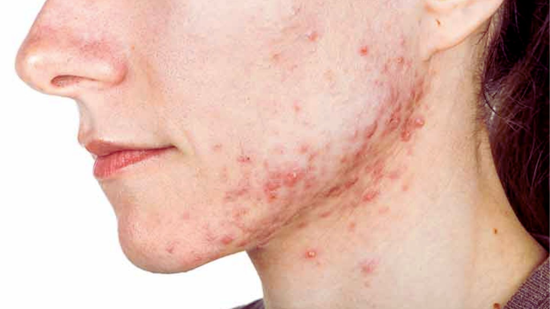 Close-up of a person's cheek and jawline with noticeable acne; red blemishes and inflamed spots cover the skin, expressing irritation and inflammation.