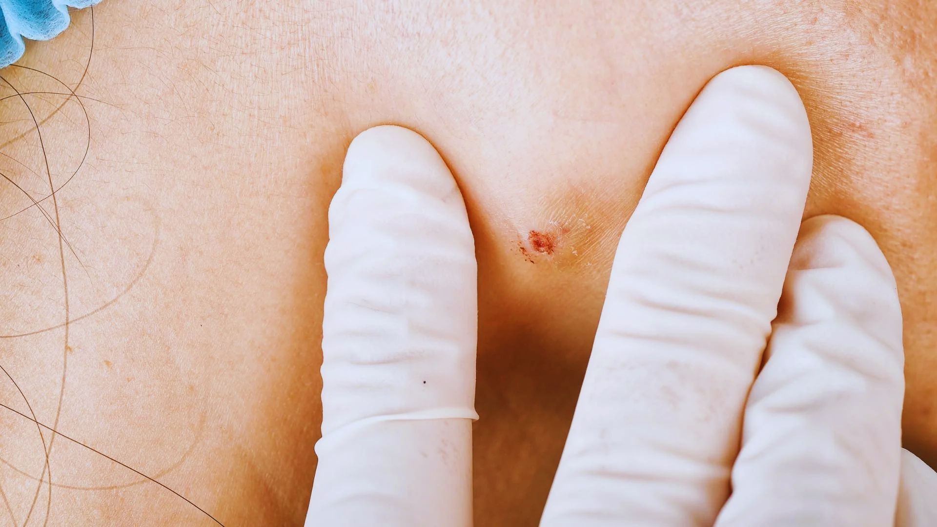 A gloved hand gently examines a small, inflamed skin blemish on someone's back. The tone conveys a clinical and cautious approach to skincare.