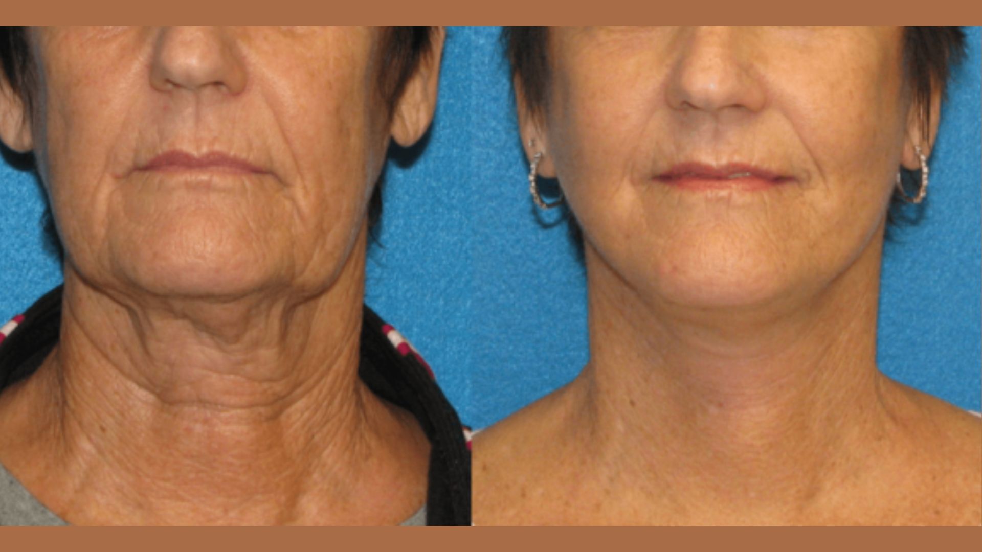 Side-by-side photos of a woman's lower face and neck, before and after a cosmetic procedure. The "before" shows sagging skin; the "after" appears smoother.