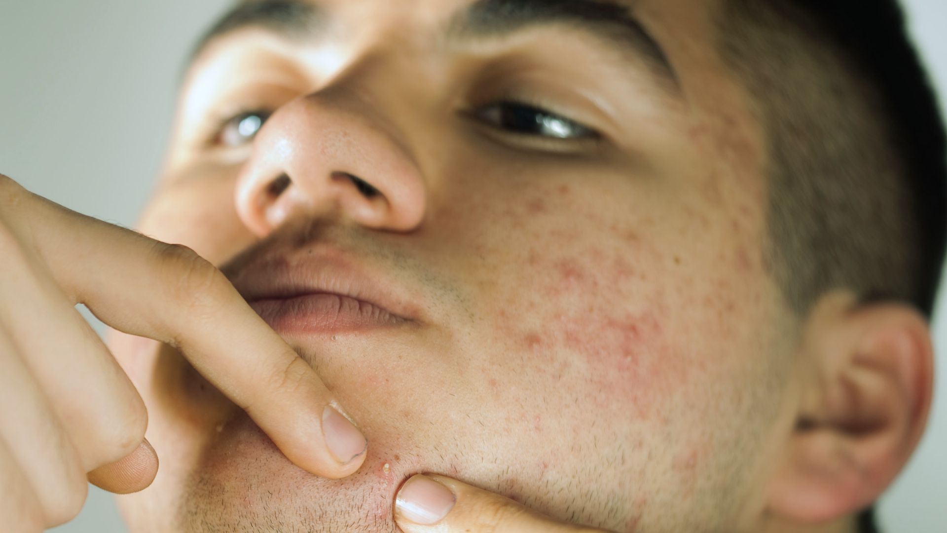 A young woman with a towel on her head examines her acne-prone skin with a concerned expression. Her hands touch her forehead thoughtfully.