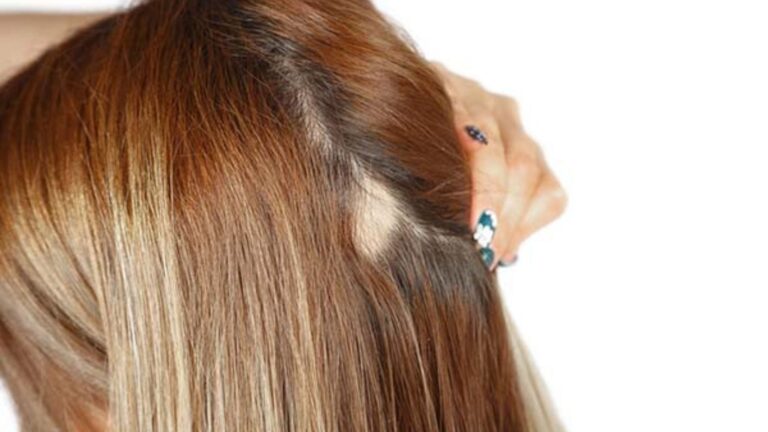 A hand with painted nails parts light brown hair to reveal a small bald patch on the scalp, highlighting hair loss against a plain white background.