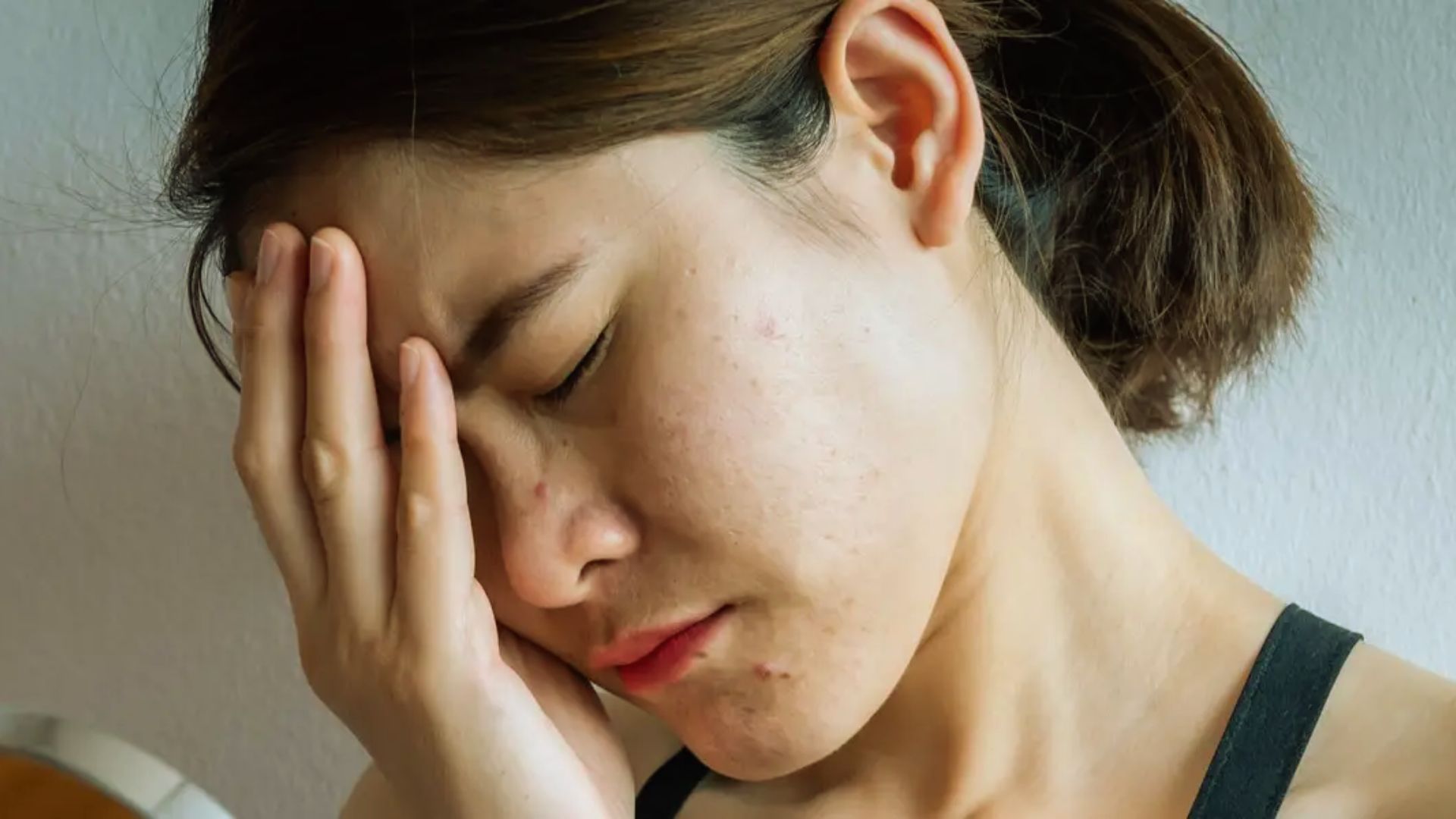 A woman with acne and closed eyes holds her hand to her forehead, conveying stress or fatigue. Her expression and posture suggest discomfort.