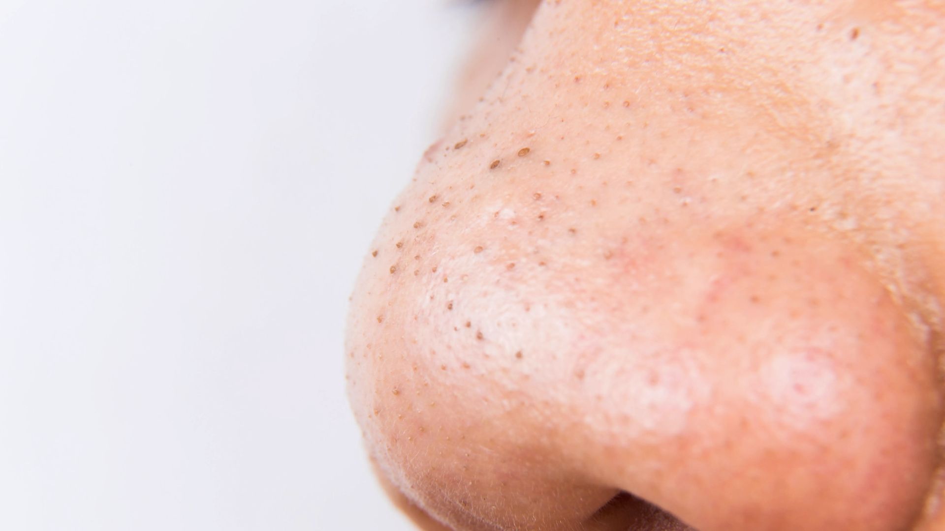 Close-up of a person's nose with visible blackheads and pores. The skin appears textured, highlighting common facial skin concerns.