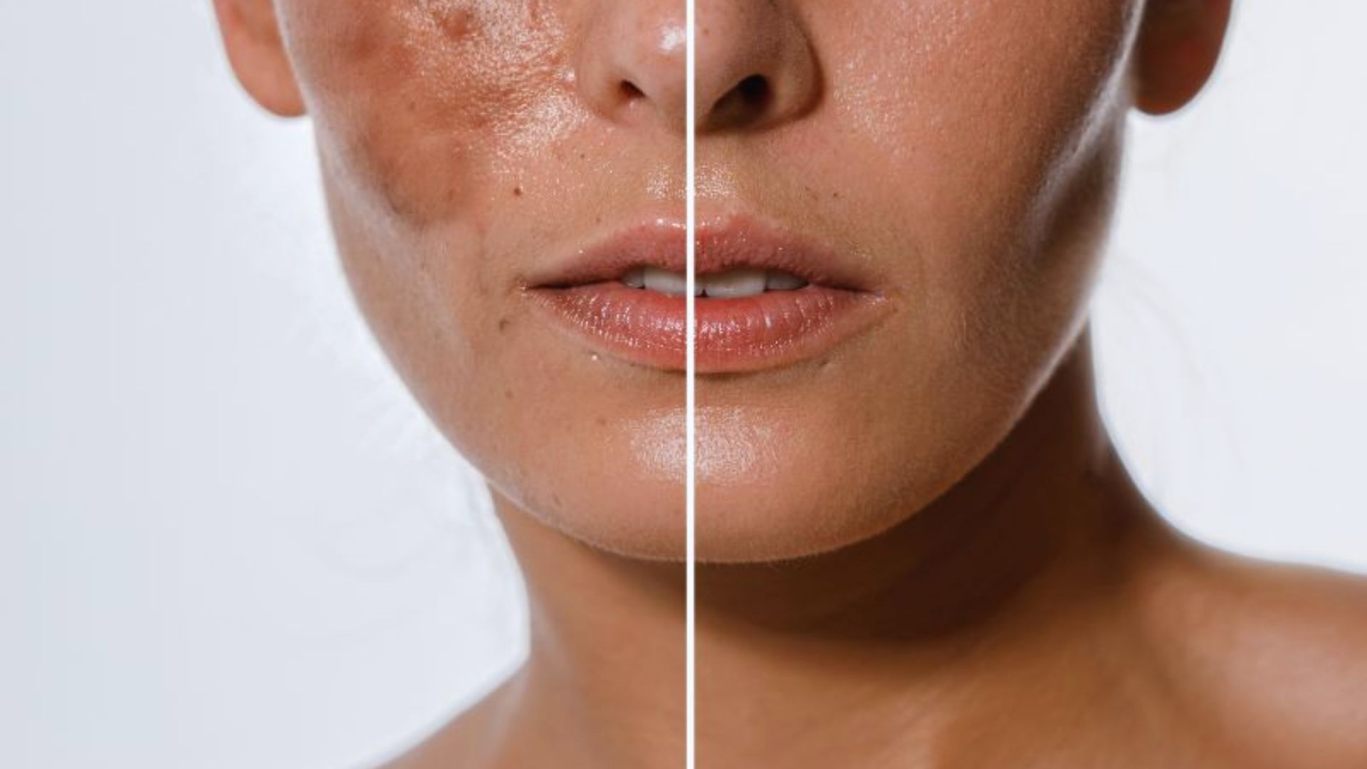 Close-up of a woman's face split in half to show skin transformation. Left side has dark spots and texture; right side is smooth and clear.