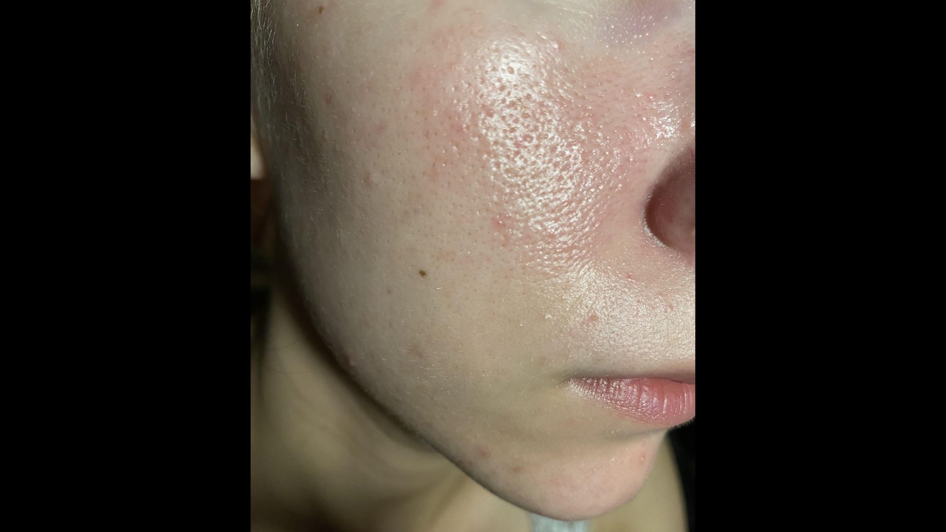 Close-up of a person's cheek with visible pores and mild redness. The skin appears textured with a focus on skincare concerns.