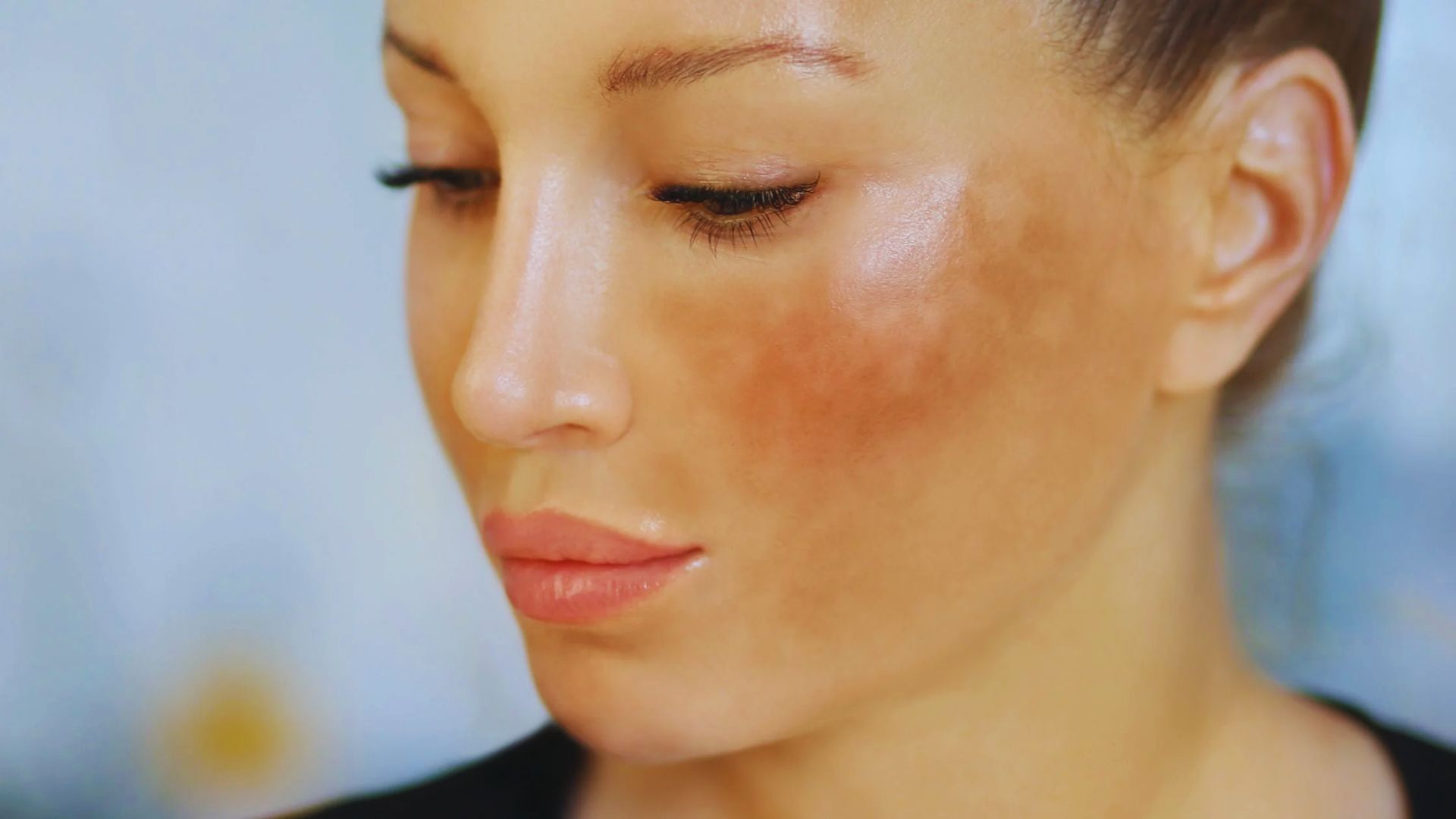 A woman with smooth skin, slightly downcast eyes, and prominent brown patches on her cheek, suggesting pigmentation. The expression is calm and reflective.