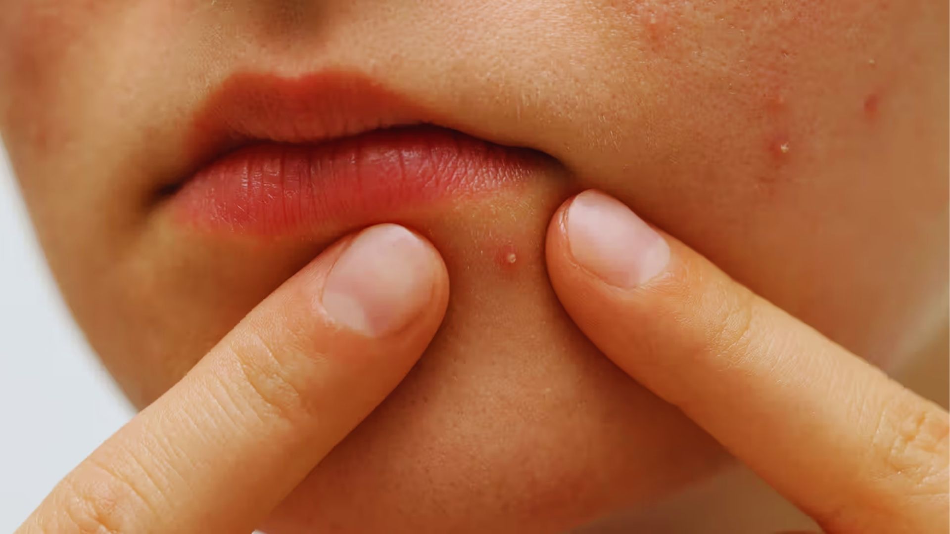 Fingers touch a small pimple on a person's cheek near their lips. Skin shows minor blemishes, suggesting a focus on skincare or acne treatment.