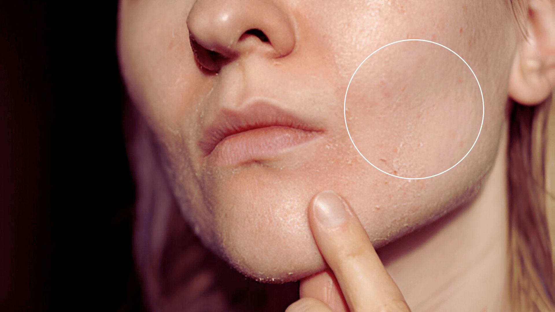 Close-up of a person's face with a focus on acne scars on the cheek. A finger points to the scars, highlighted by a white circle. Skin appears textured.